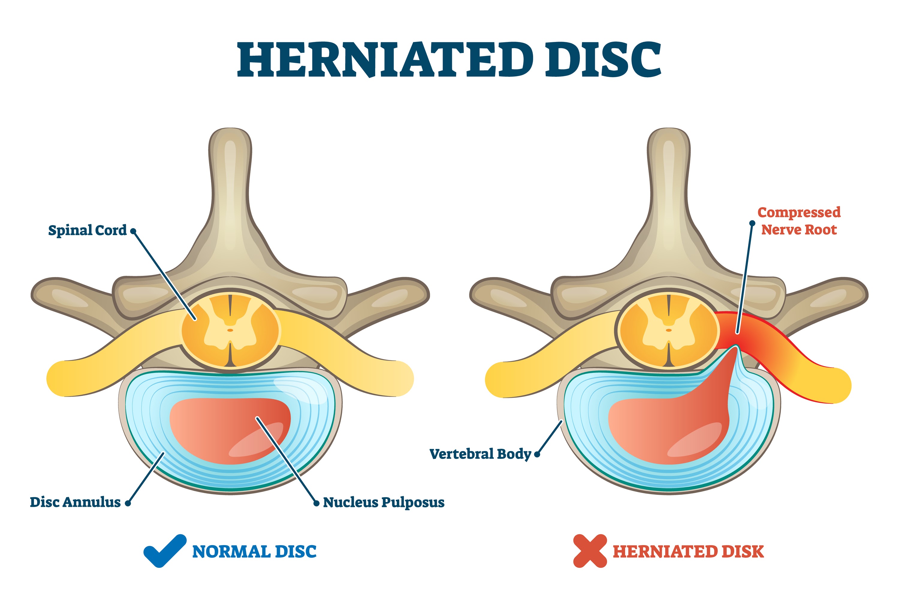 Illustration of lumbar disc herniation