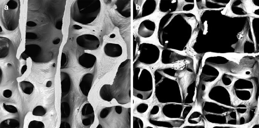 Illustration of osteoporosis