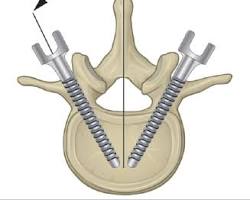Image of a spinal fixation procedure