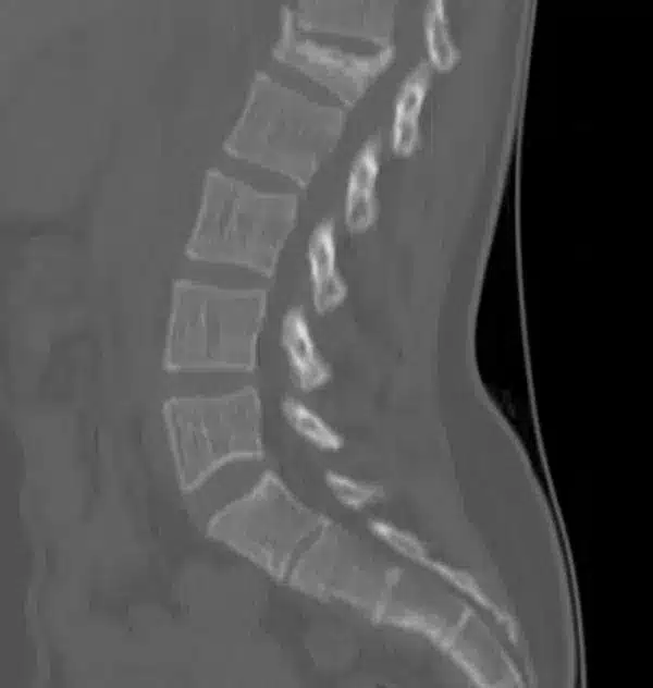 Image of a fractured vertebra